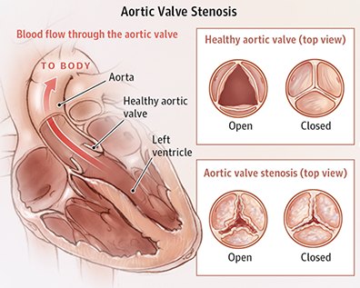 aortic-valve-stenosis