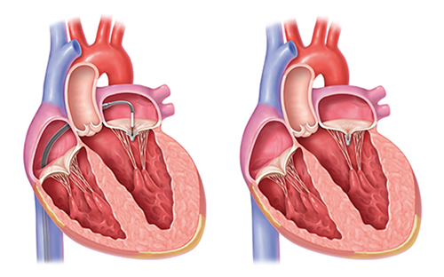 MitraClip Procedure