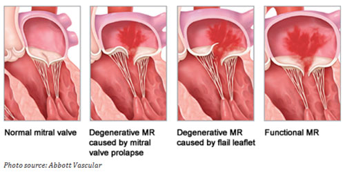 mitral regurgitation types