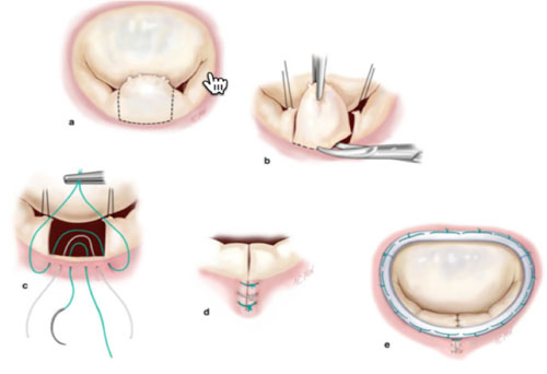 Mitral valve replacement after transcatheter aortic valve implantation in a  patient with rheumatic heart disease and prior Ross procedure: a case  report | The Egyptian Heart Journal | Full Text