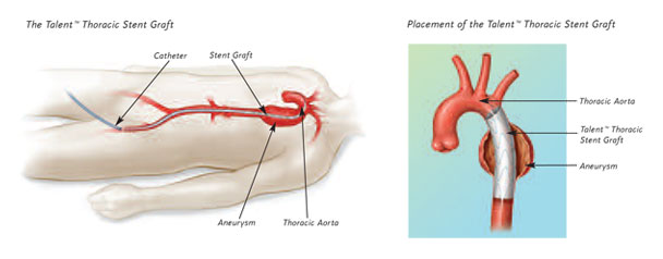 life expectancy after thoracic aortic aneurysm surgery