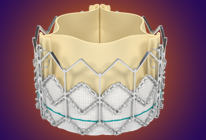 tavr-procedure-th2